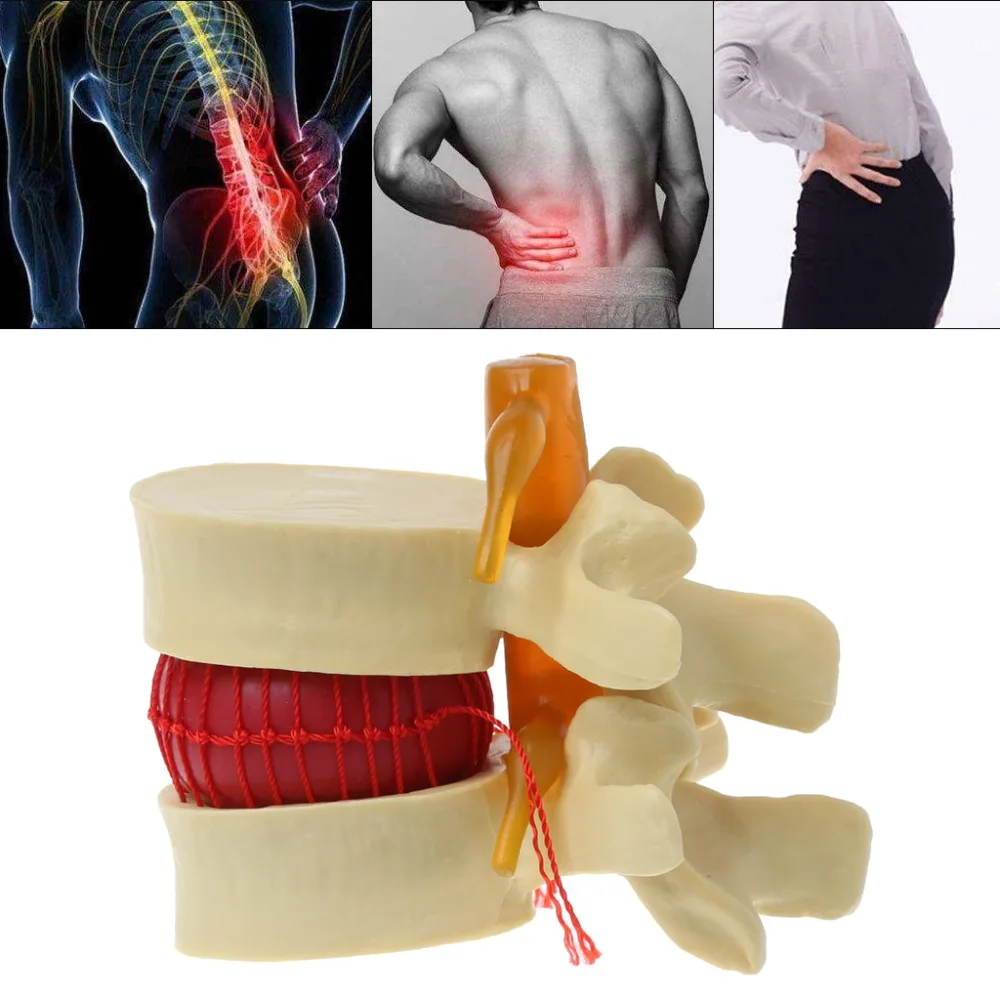 Anatomical Spine Lumbar Disc Herniation Anatomy Medical Model Teaching Tool School Supplies Instrume C26 | Канцтовары для офиса и