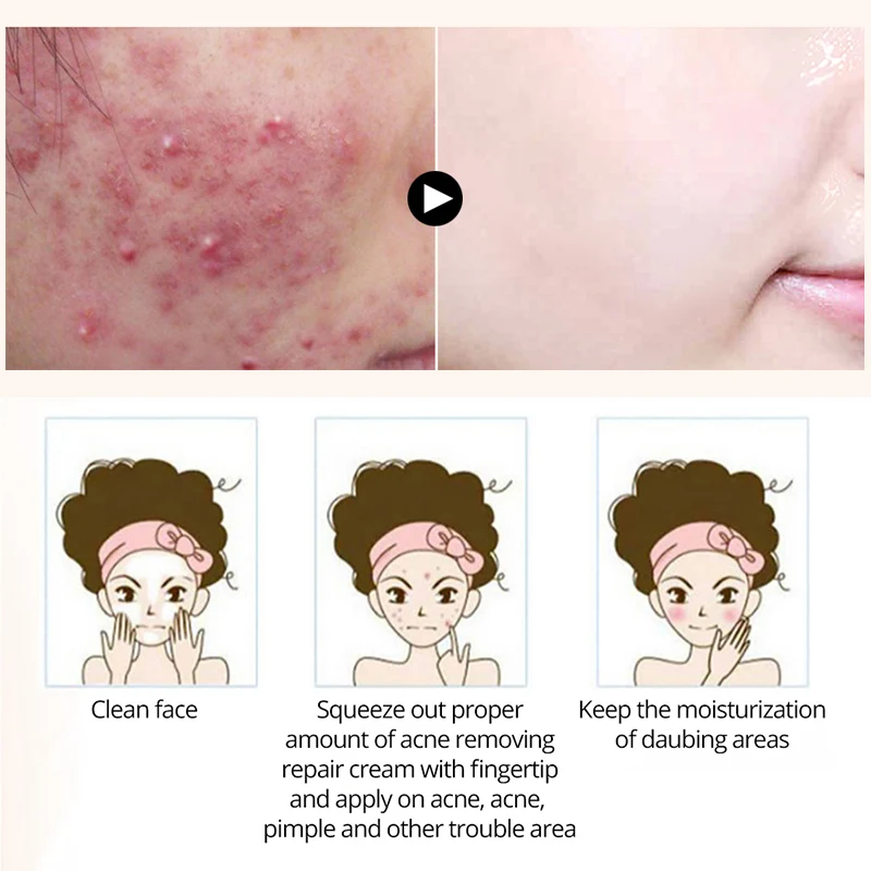 BEACUIR Rejuvenation Acne Cream Anti Treatment Scar Removal Whitening Moisturizing Shrink Pores Beauty For Face Skin 20g | Красота и