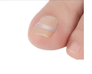 NEW 10pcs/box Fixer Pedicure Recover Ingrown Sticker Patch Foot Care Toe Nail Tool Correction File Acronyx Bunion Wire Corrector | Красота и