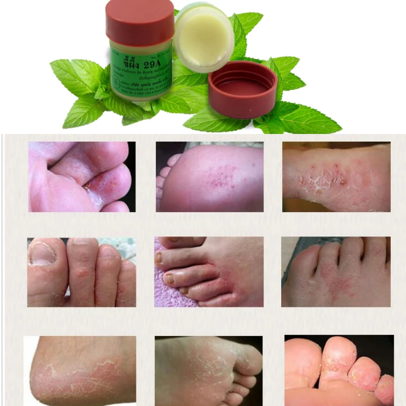 Китайская мазь Psoriasi Eczma Cream 2 шт. идеально подходит для проблем с все виды кожи 02 |