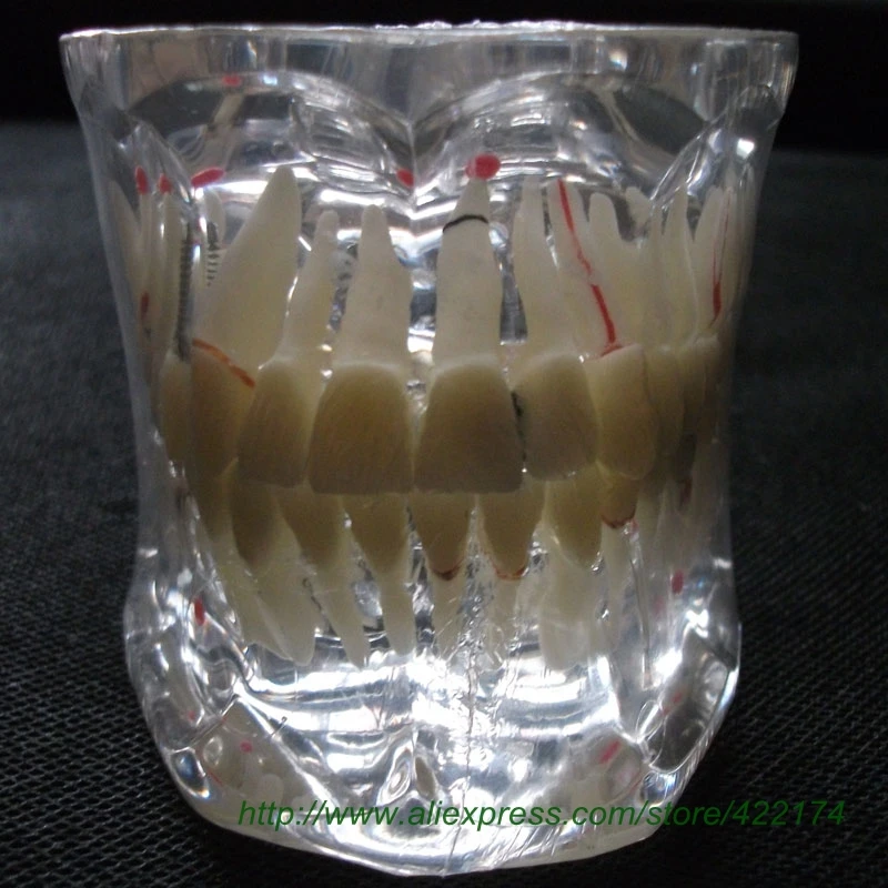 

Free Shipping Adult pathologies model dental tooth teeth dentist anatomical anatomy model odontologia