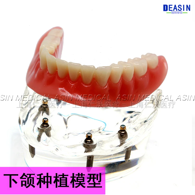 1 pc x high quality Resin Coverage dental implant model dentures Removable teeth for dentist study Deasin |