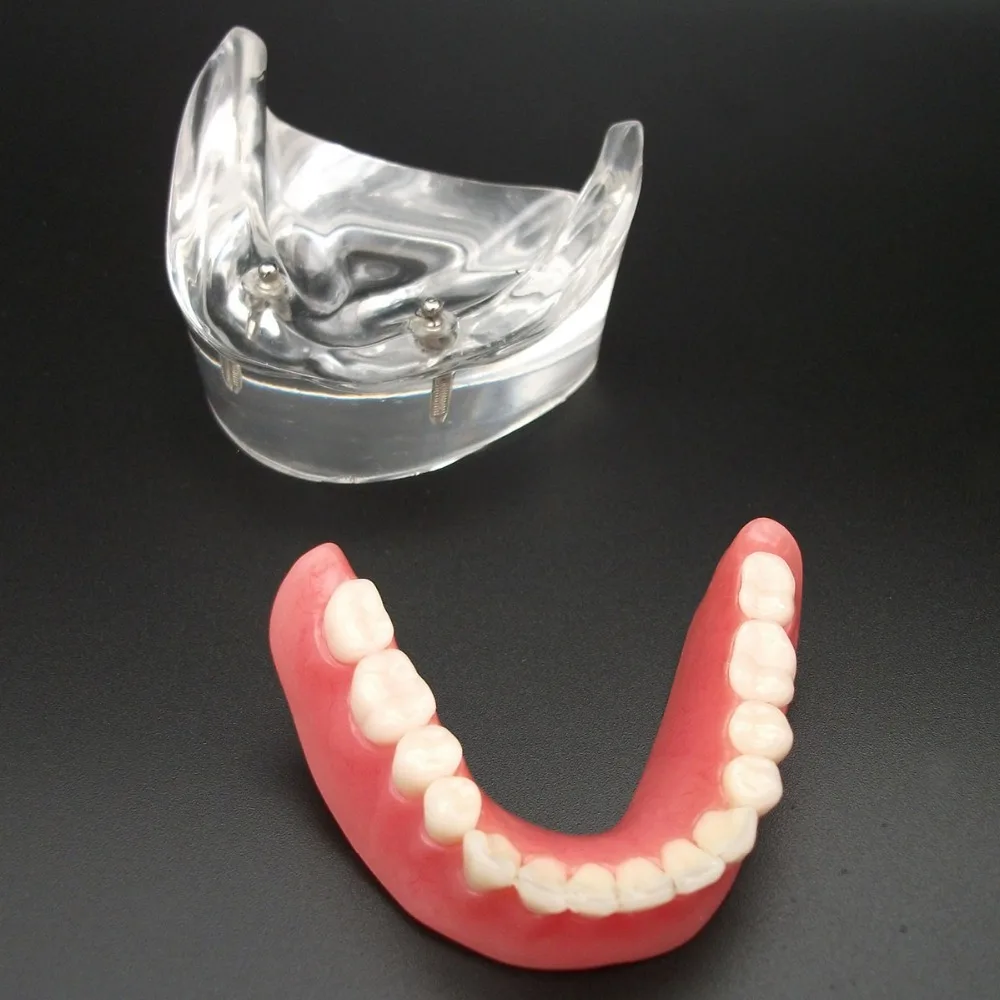 

Dental Overdenture Inferior With 2 Implants Demo Model Study Model