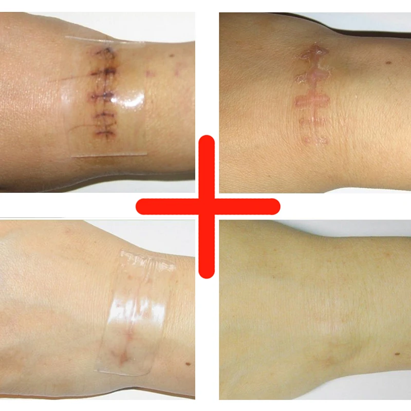 1 шт. силиконовый Патч Бесплатная доставка шрам удаление силикона для удаления