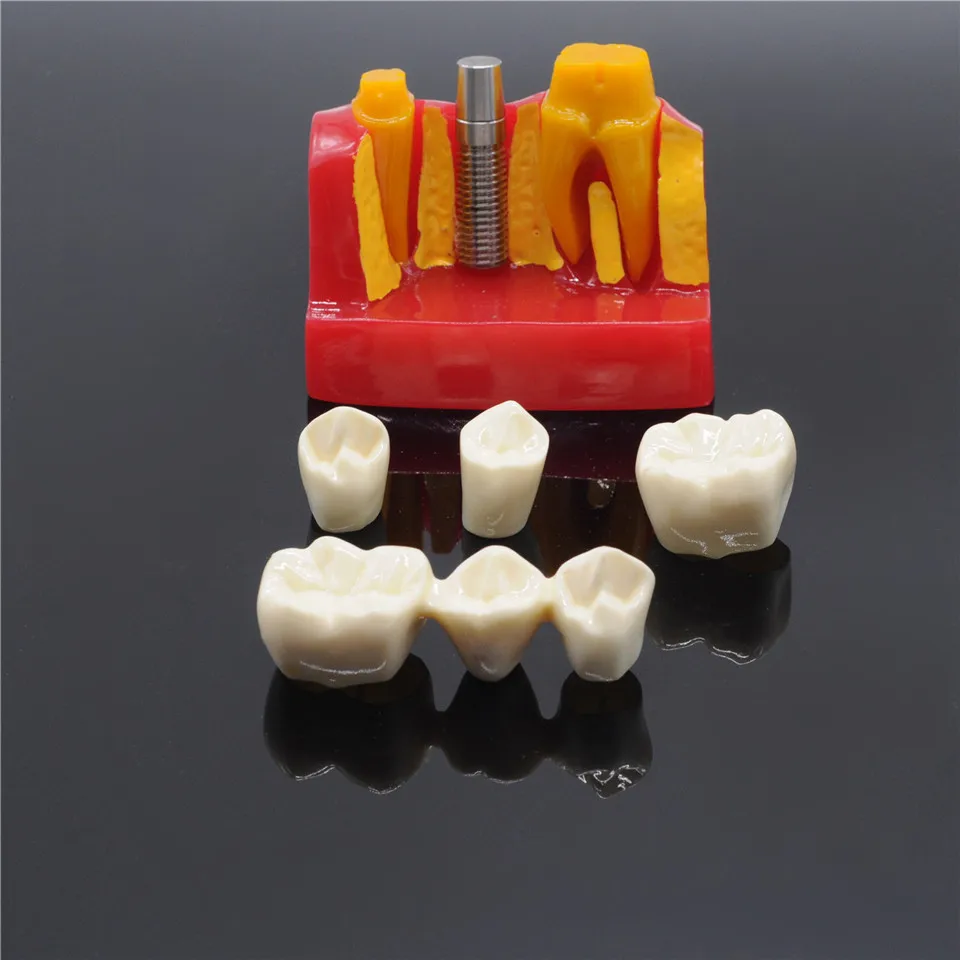 Лабораторные принадлежности анализ зубных имплантов корончатый мост