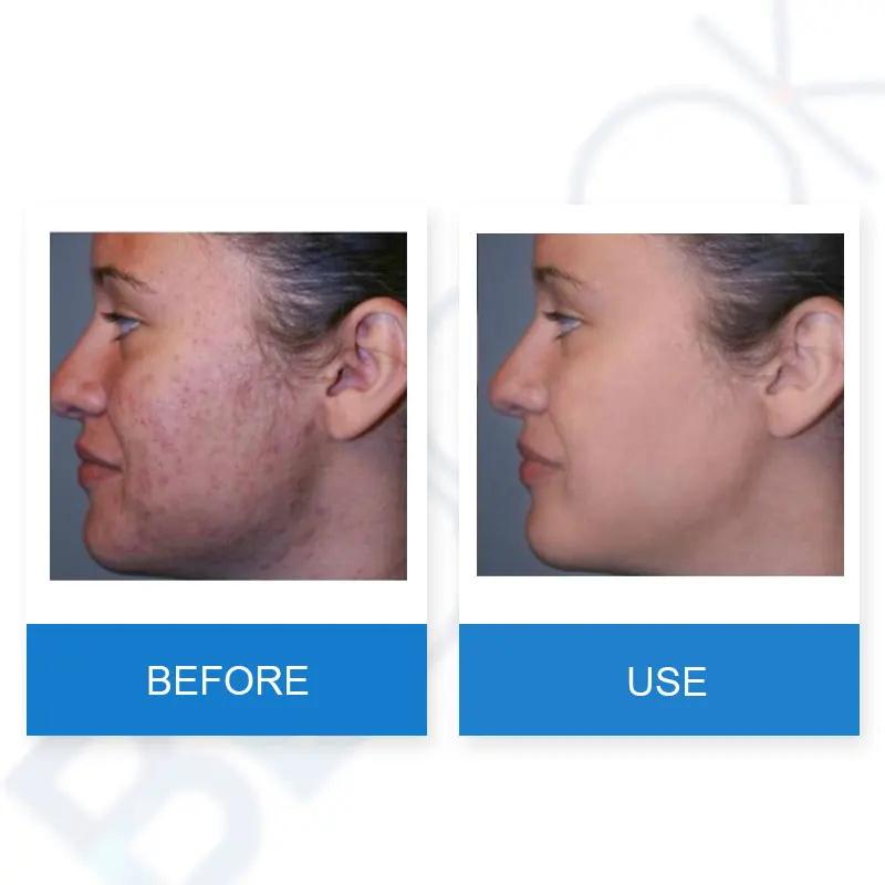 BEDOOK чистая кожа поры затягивания и шрамы кремы Acne лечения акне рубцов удаление