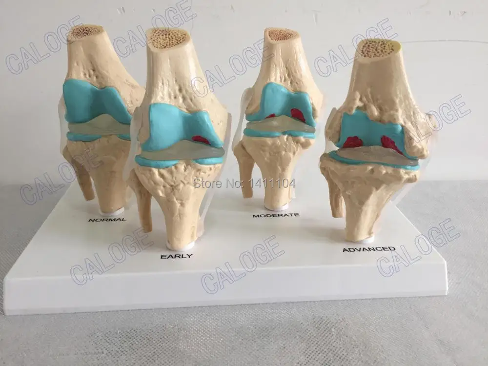 

Special deals are on sale&Human knee joint disease model, bone tissue,four stage, Department of orthopedics model medical.
