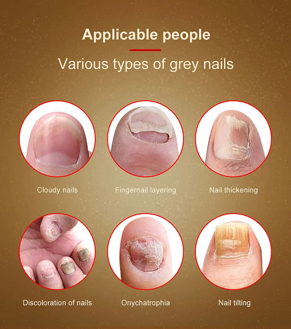 Средство для лечения ногтей от грибков эссенция ухода за ногами отбеливания на