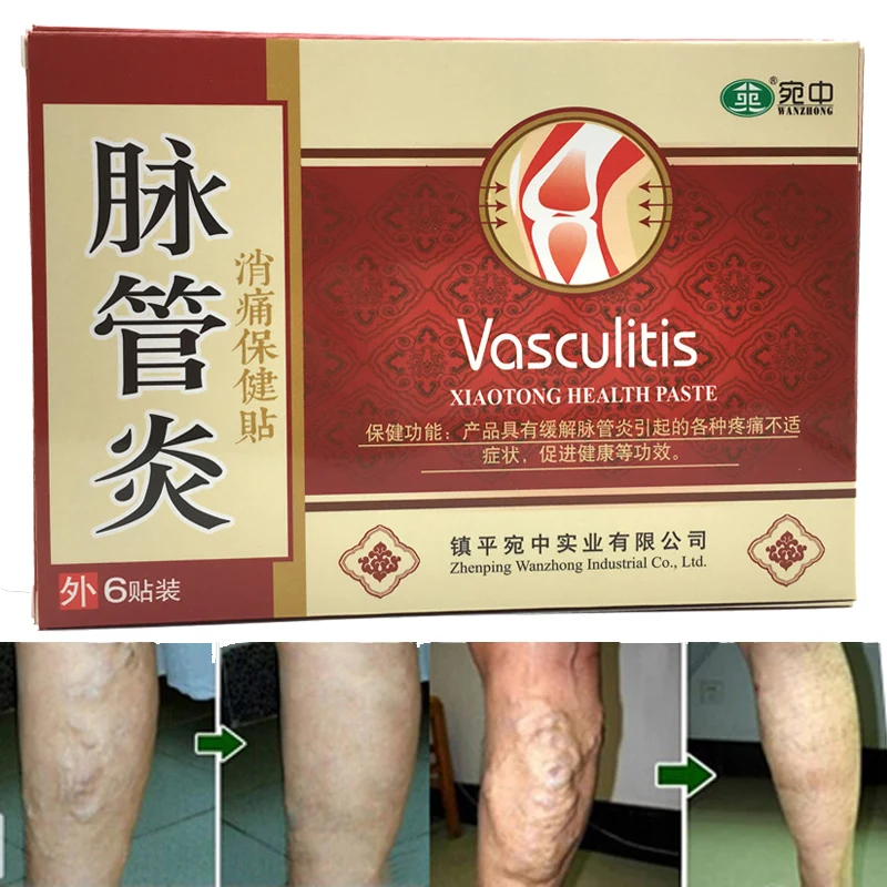 18 шт. пластыри от варикозного расширения вен|chinese herbal treatment|varicose veinsvein patches |