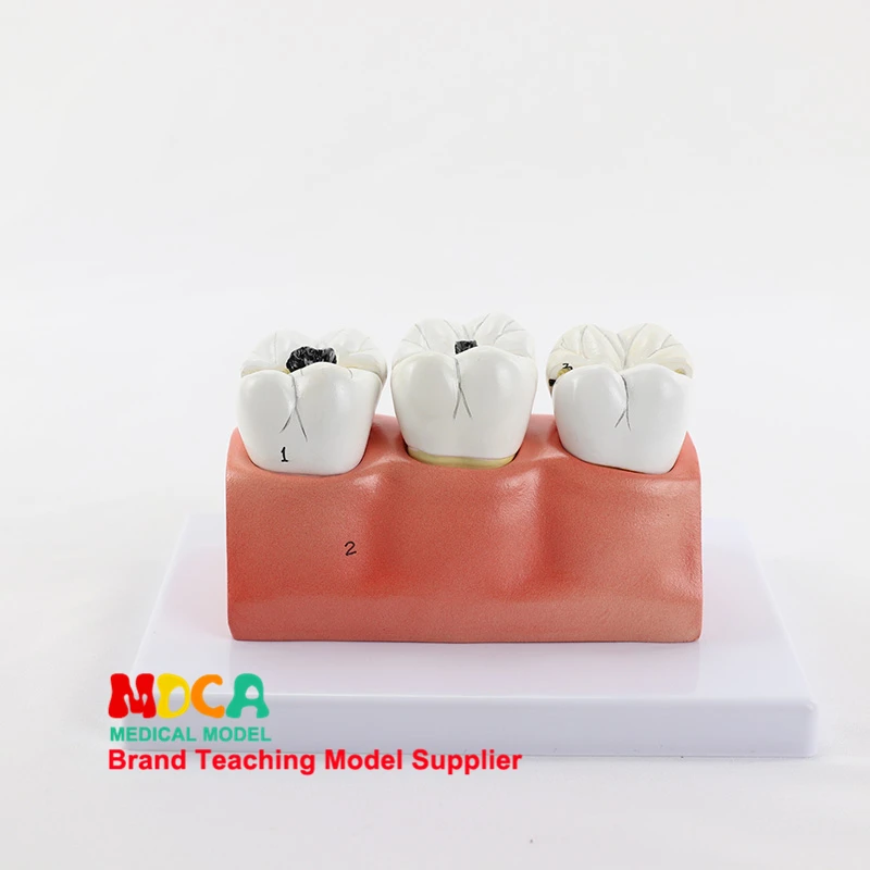 Dental caries decomposition model dentistry oral dentistry display medical teaching model MYC008 delian one step desensitizer dental medical product caries prevention and oral hygiene desensitizing prevents hypersensitivity