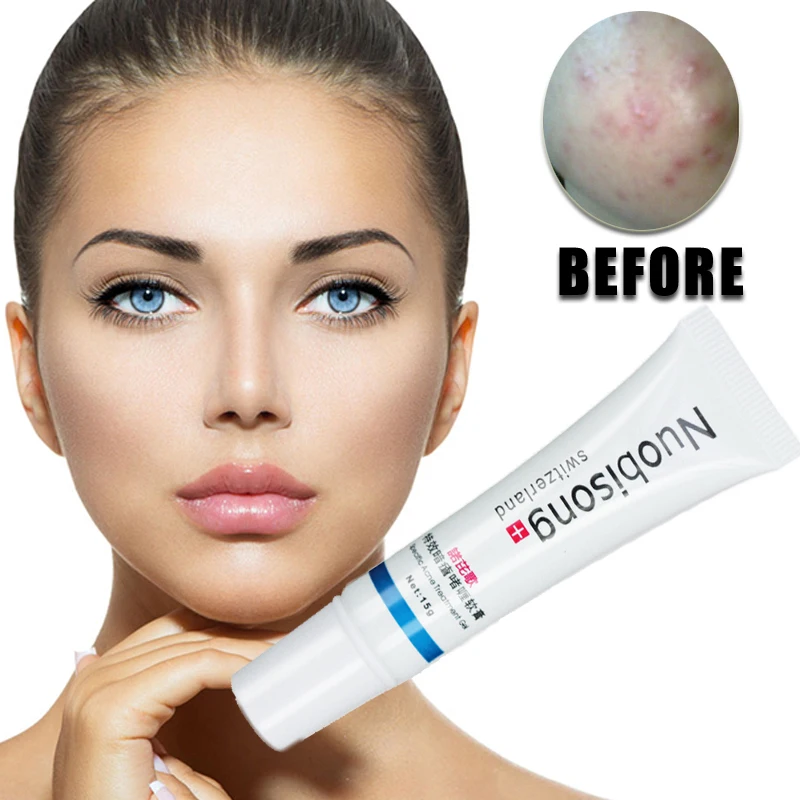 

Nuobisong/Face Skin Care Treatment The Face Pimples Scar Stretch Marks Removal Acne Treatment Whitening Moisturizing Cream