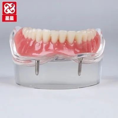 

Micro planting Repair model Dental Teaching Patient communication free shipping