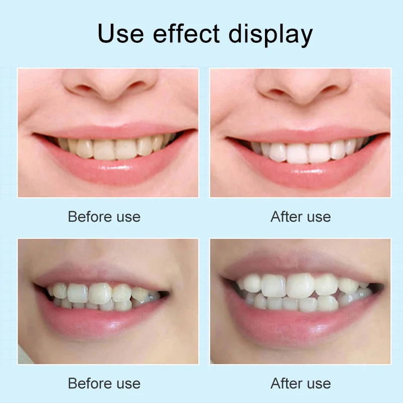 3g ручка для отбеливания зубов удаление пятен уход за полостью рта чистка