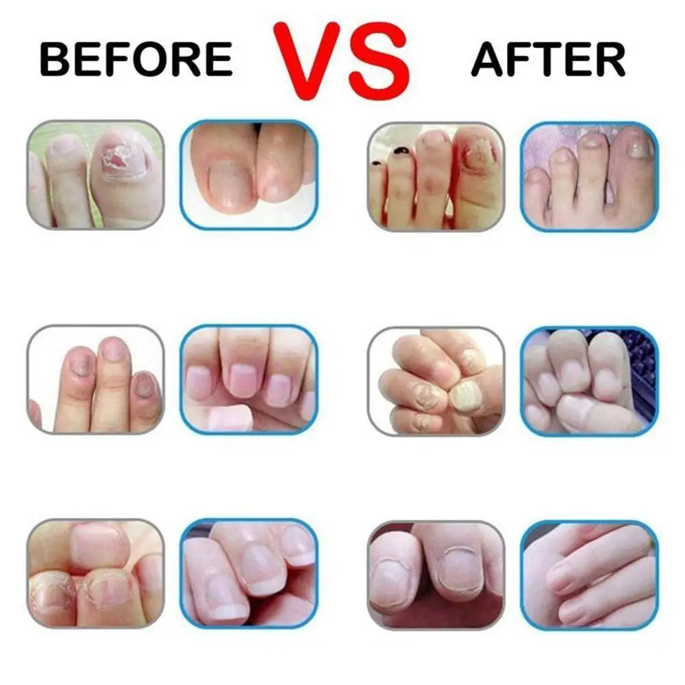 Лечение ногтей жидкая ручка Onychomycosis Paronychia противогрибковые инфекция носок