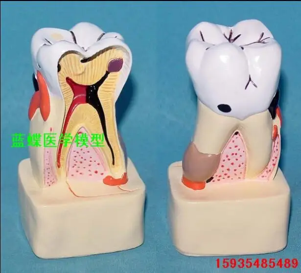 Dental cavity model dental disease comprehensive pathological anatomy profile doctor-patient communica | Канцтовары для офиса и