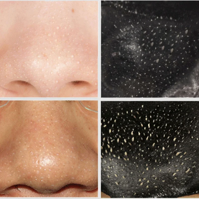 Новая маска для удаления угрей Нос Маски лица лечение акне пилинг очищения пор