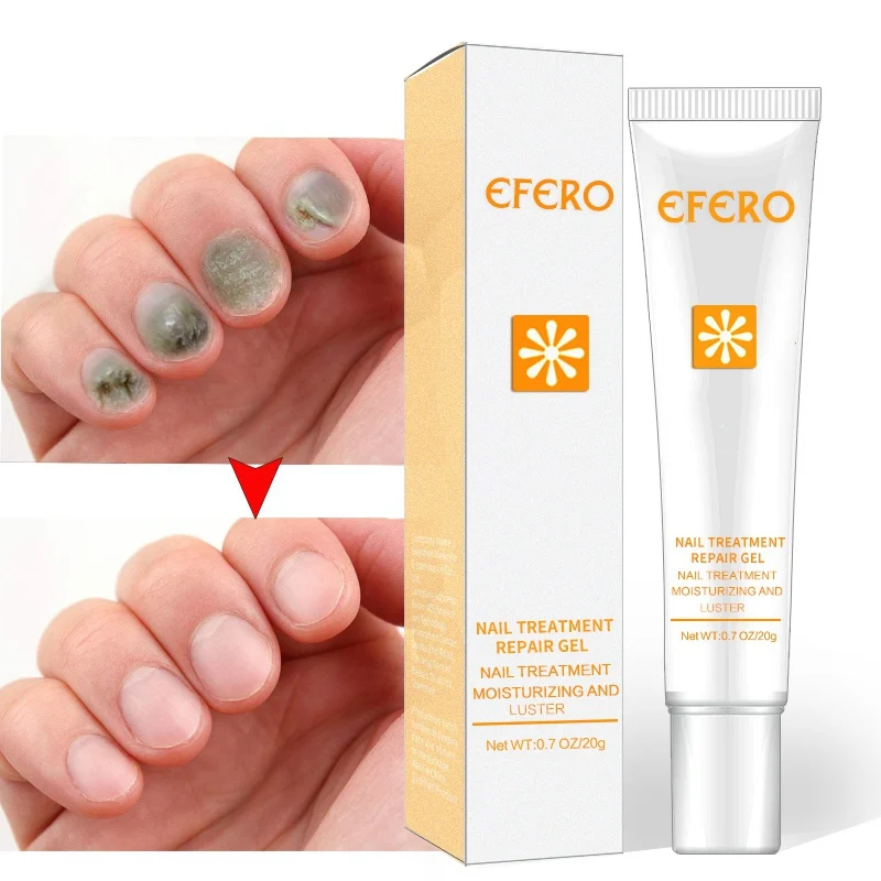 Nail Treatment Repair Gel Growth Product Remove Onychomycosis Broken Treatments | Красота и здоровье