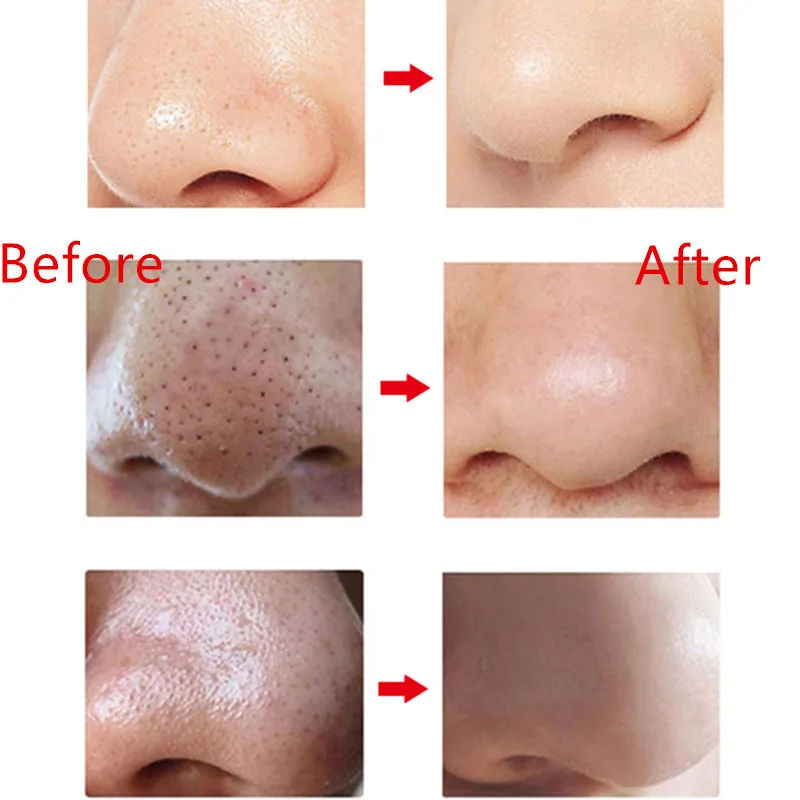 Электрический пылесос для удаления черных точек лица носа прыщей в черный