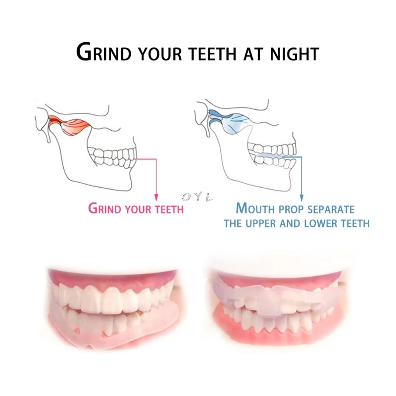 

Anti Grinding Teeth Protector Dental Mouth Guard Grinding Bruxism Gum Shield