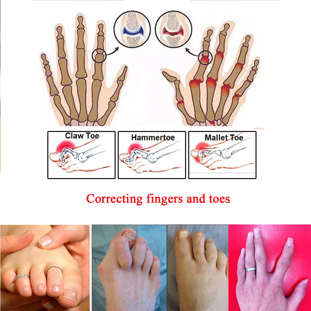 8 шт. Скоба для пальцев шина поддержки артрита травмированного пальца также