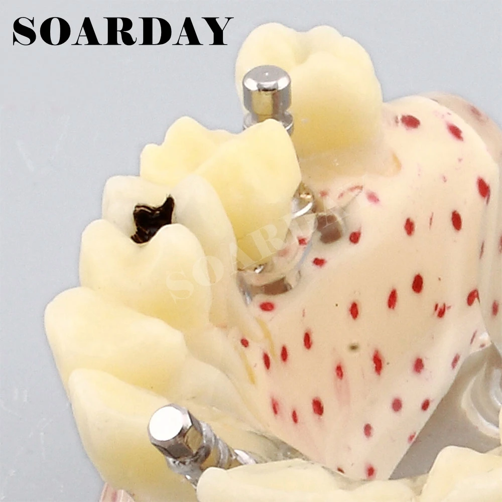 Зубная модель импланта для имплантации верхних зубов губчатая кость кариз|dental