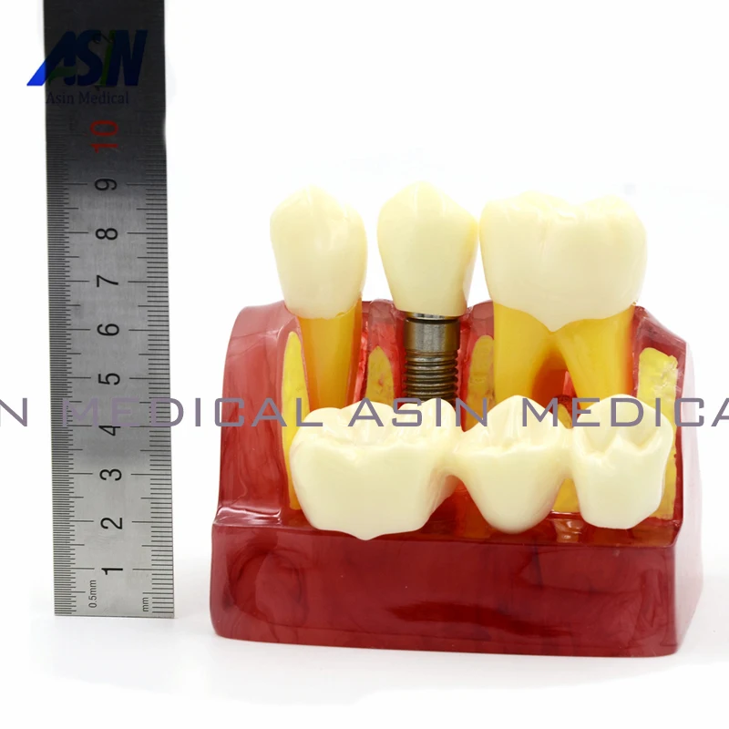 

MACRO IMPLANT TEETH MODEL CROWN BRIDGE DEMOSTRATATION TEETH TOOH TYPODONT DENTOFORM