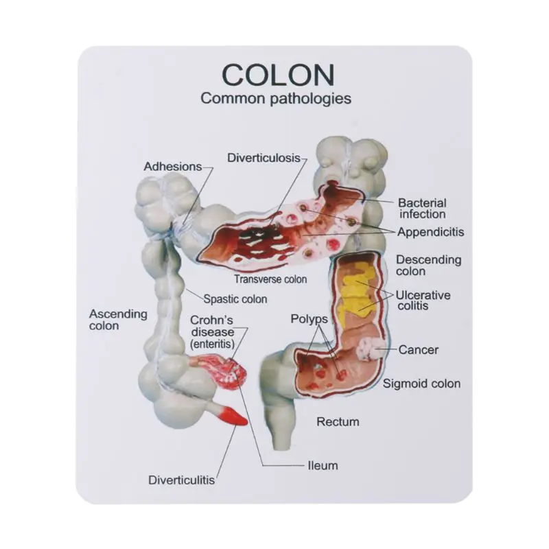 

2019 NEW Human Colorectal Lesion Model Pathological Anatomy Colon Diseases Intestine Medical Teaching Learning Tool Dropshipping