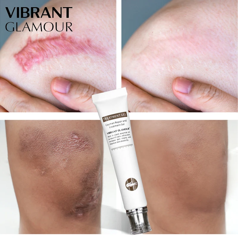 

VIBRANT GLAMOUR Repair Scar Cream Removal Scars For Face Or Body Pigmentation Corrector Scalded Surgery Scar Insect Bites Mark