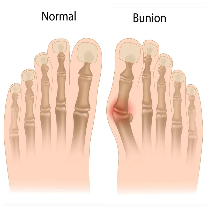 1 пара мягкие детали для измерения вальгусной деформации|foot care tool|care toolbunion orthotics |