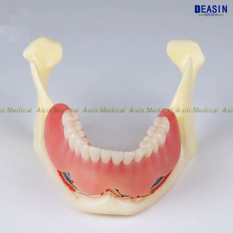 Dental High Quality Resin Mandibular Fenture Coverage Model Mandible Belt Nerve Model Display Dentures Removable Teeth Model