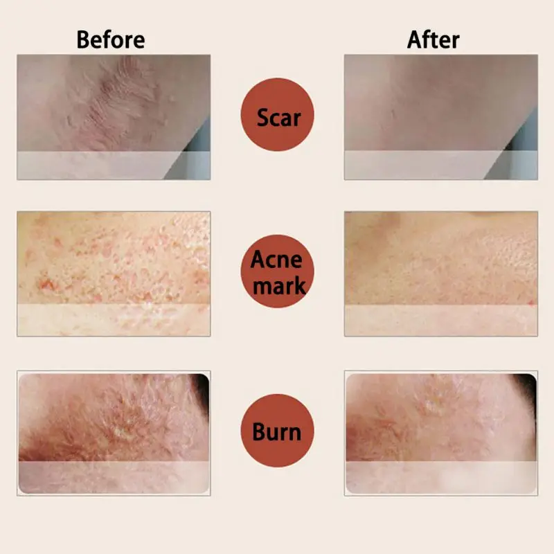 10 мл эссенция полного тела отбеливающая курица ремонт кожи эфирные масла удаляет