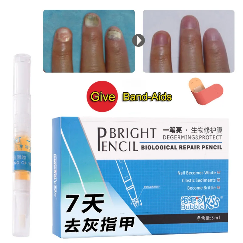 Лидер продаж антигрибковый крем-ручка для ногтей Лечение грибка инфекция яркий