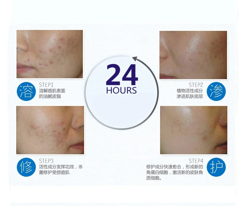 30 г анти акне крем уход за лицом шрама порока стрейч Знаки увлажняющий Уход