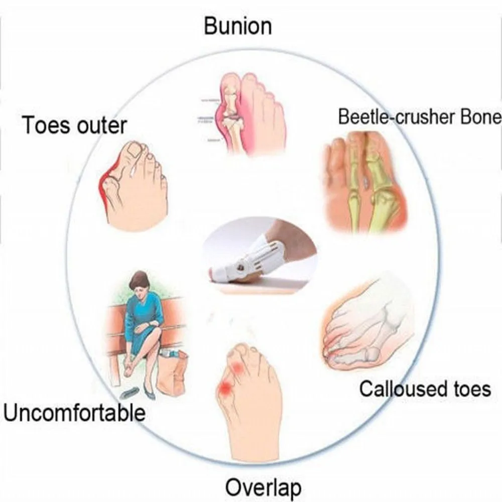 1 Pair Big Bone Toe Hallux Valgus Bunion Splint Corrector Orthotics Pro for Pedicure Orthopedic Braces Feet Care Tool | Красота и