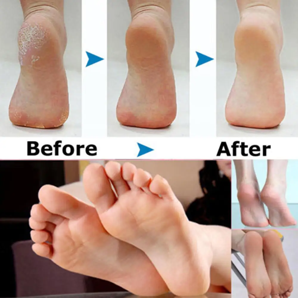 5 шт./компл. Сменные Роликовые головки для Amope Pedi Perfect Express средство удаления