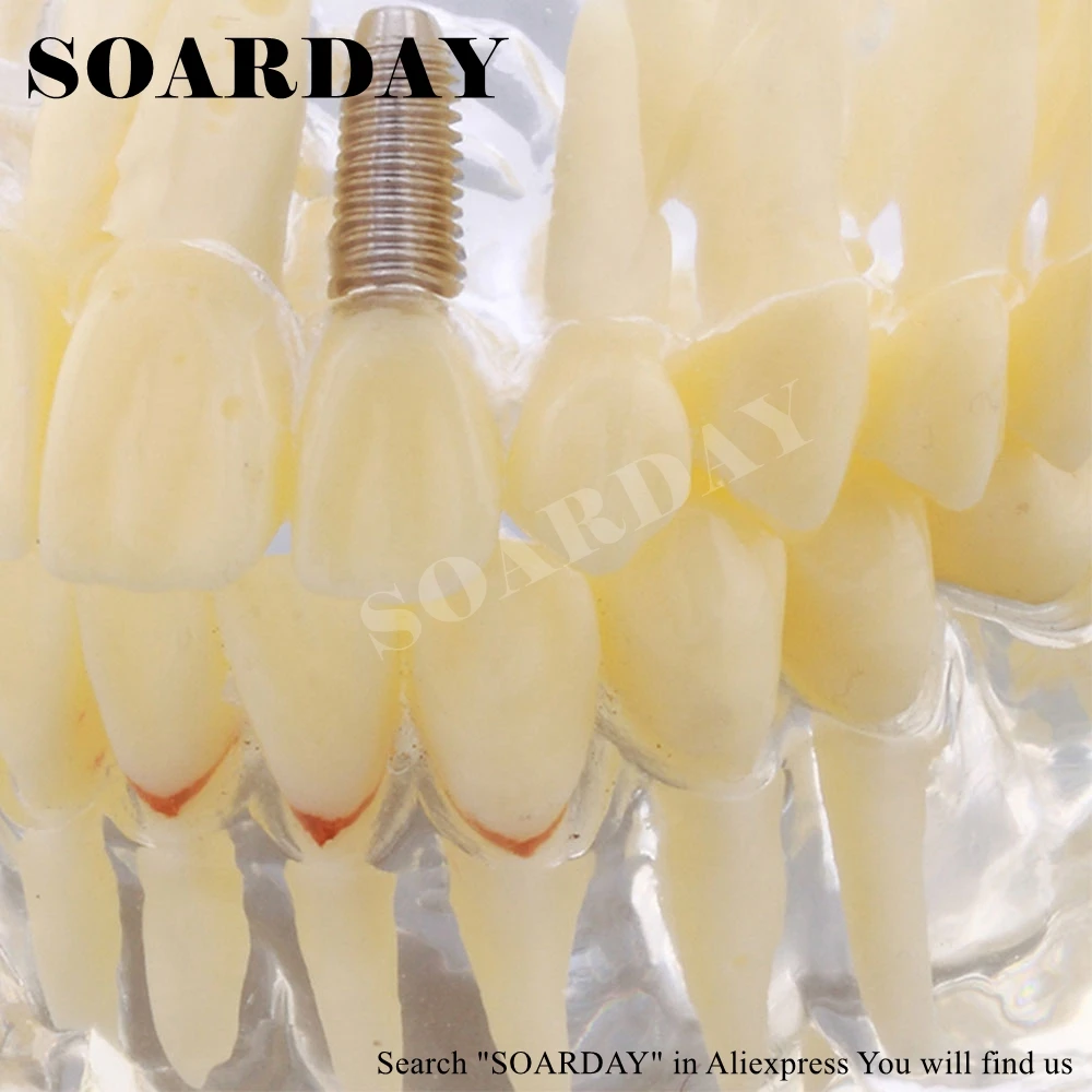 1 шт. стоматологическая патологическая модель импланта SOARDAY|bridge implant|implant modeldental