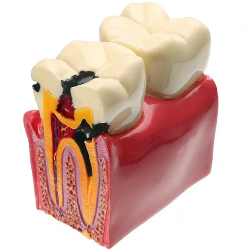 

Стоматологические материалы, 1 шт., лабораторная модель зубов, 6 раз, кариес, исследования моделей для стоматолога, изучение и исследование