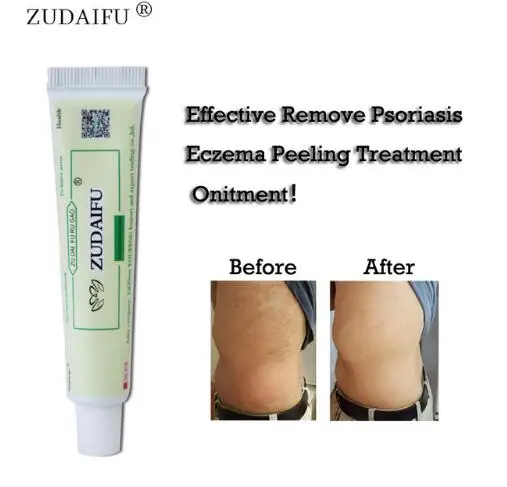 

10PCS Hot selling ZUDAIFU Body Psoriasis Cream without Retail Box Skin Care