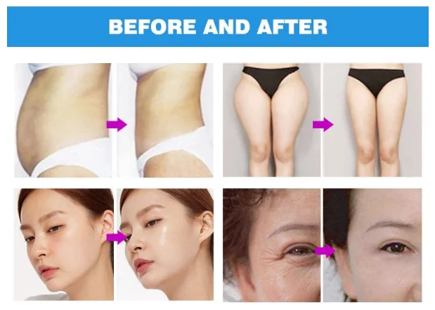Velashape 3 rf кавитационная машина для похудения, вакуумная роликовая машина для целлюлита