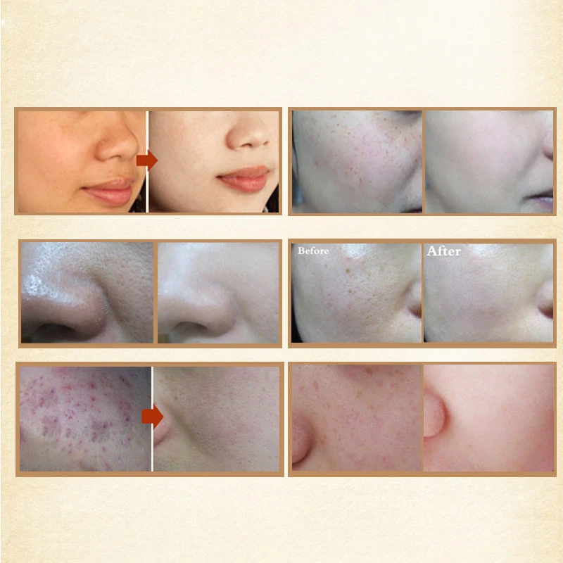 120 г Роза отбеливающая маска для лица удаление веснушки исчезают темные пятна
