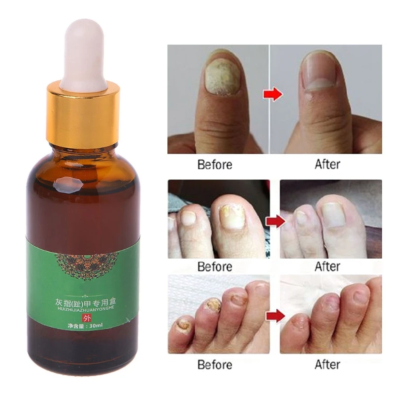 Грибковая эссенция для лечения Ногтей средство ремонта пальцев и от грибка 30