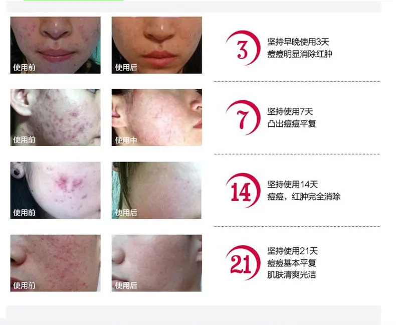 New Aloe Acne Vulgaris Scar Whelk Pimple Zit Zun Remove Vanishing Dispelling Plaster Cream Skin Care Treatment Face Care