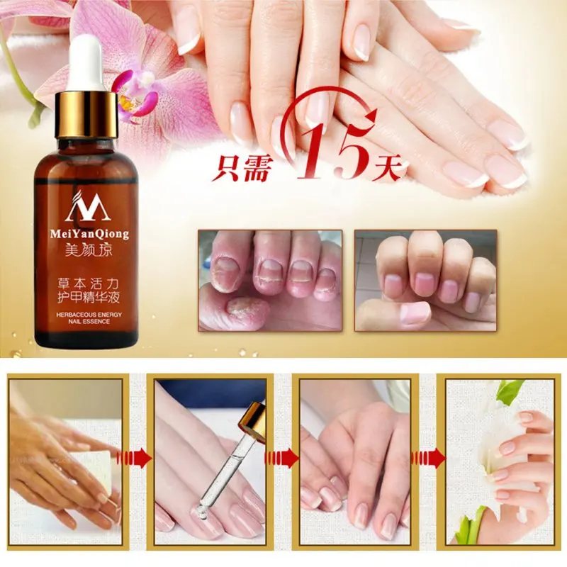 

30ml Fungal Nail Treatment Essence Nail and Foot Whitening Toe Nail Fungus Removal Feet Care Nail Gel