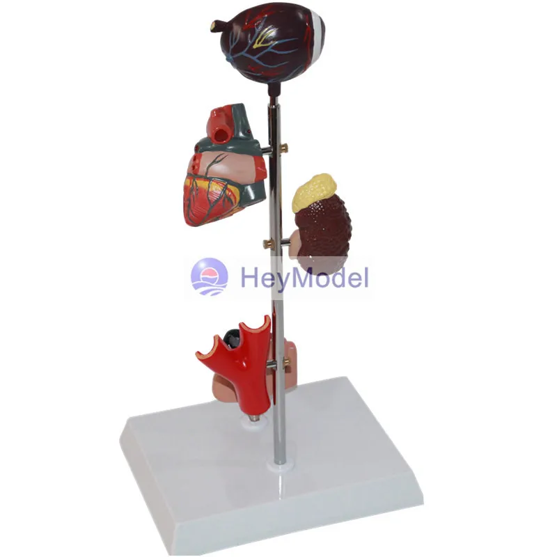 HeyModel человеческий диабет модель очага повреждений|Образовательное