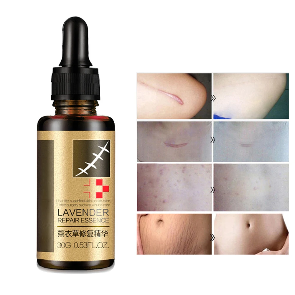 Удаление шрамов прочный Лавандовый шрам ремонт эссенция биологическое