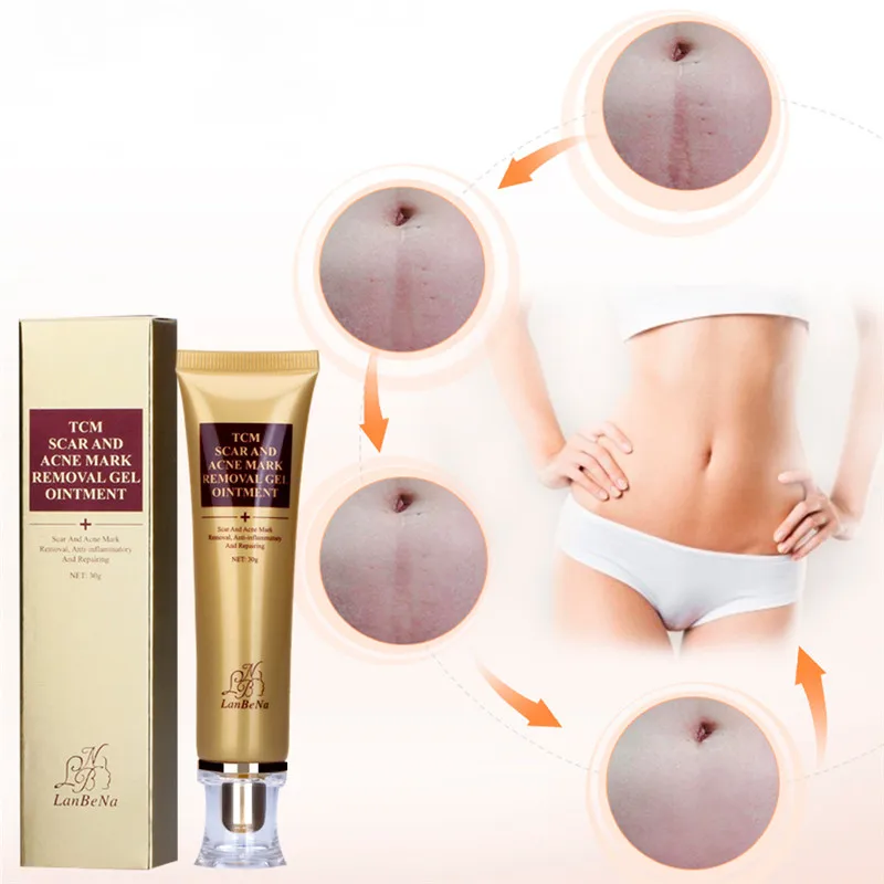 2018 Горячая Распродажа крем для удаления рубцов от акне растяжки шрамов лечение