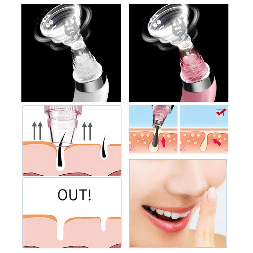 Профессиональный вакуумный инструмент для удаления угрей средство точек лица