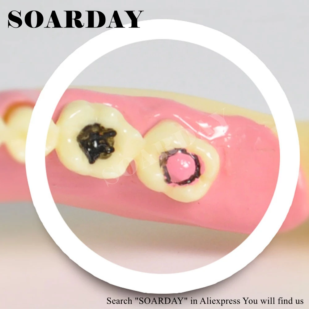 

Lower Jaw Pathological Model Dental Caries Communication Model Resin Material Nerve Display