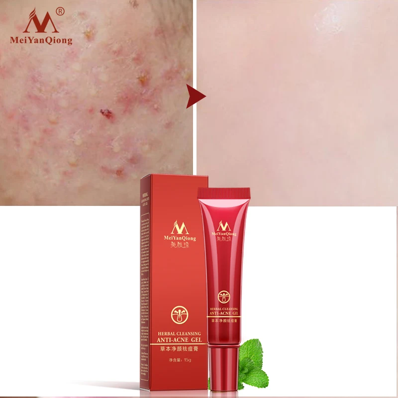 Высокоэффективное травяное Очищение лица от акне средство для удаления рубцов