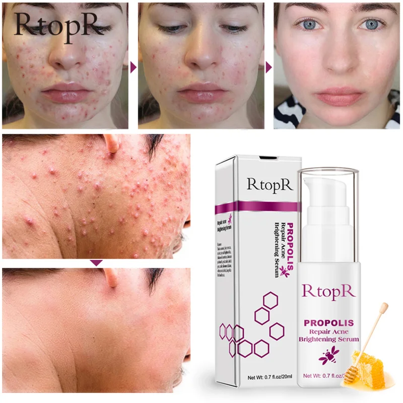 Прополис сыворотка для лечения акне восстановление осветление сужение пор